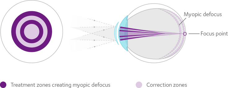 Misight how contact lenses work infographic